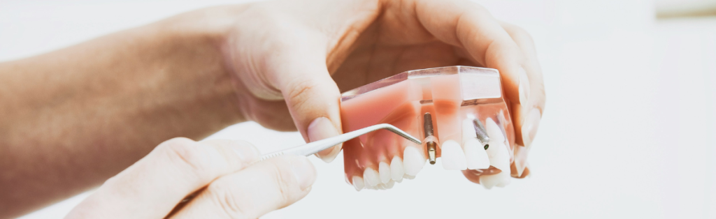 Prótesis dental con implantes odontológicos utilizados en tratamientos dentales en España. Homologar título de odontología en España.